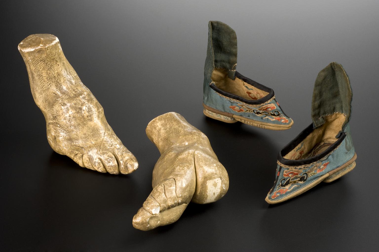 A photograph featuring plaster models of feet deformed by Chinese practice of foot-binding and a pair of shoes with low heel and pointed toe, silk uppers, embroidered in silk thread over paper, worn by Chinese women in the 19th century.