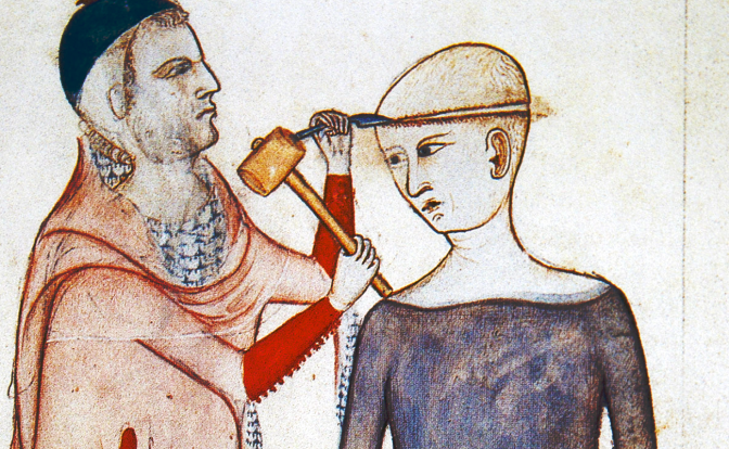 A medieval sketch depicting the practice of trepanning. A man is seen using a hammer and chisel to create an opening in a woman's skull.