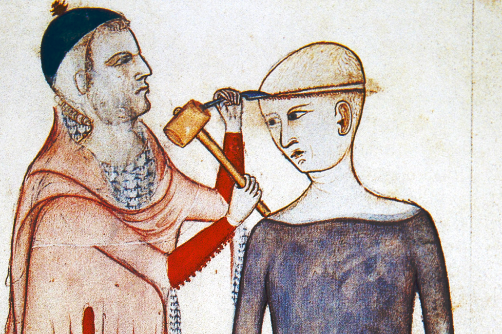 A medieval sketch depicting the practice of trepanning. A man is seen using a hammer and chisel to create an opening in a woman's skull.