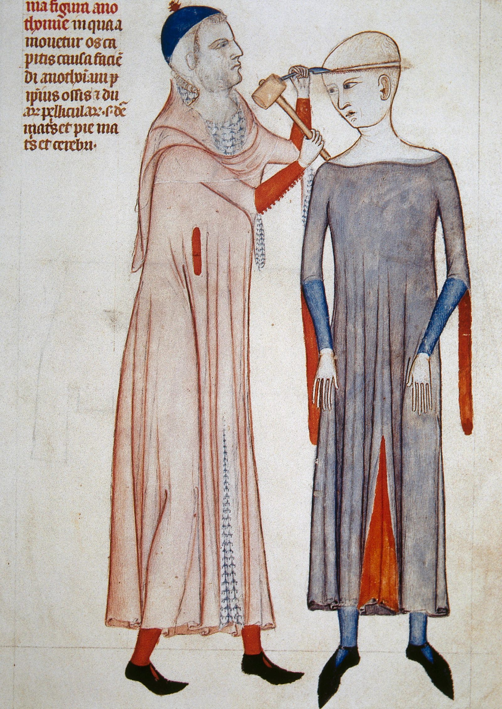 A page from a medieval book featuring a depiction of the trepanning procedure. A man is using a chisel and hammer to make a hole in a woman's skull.